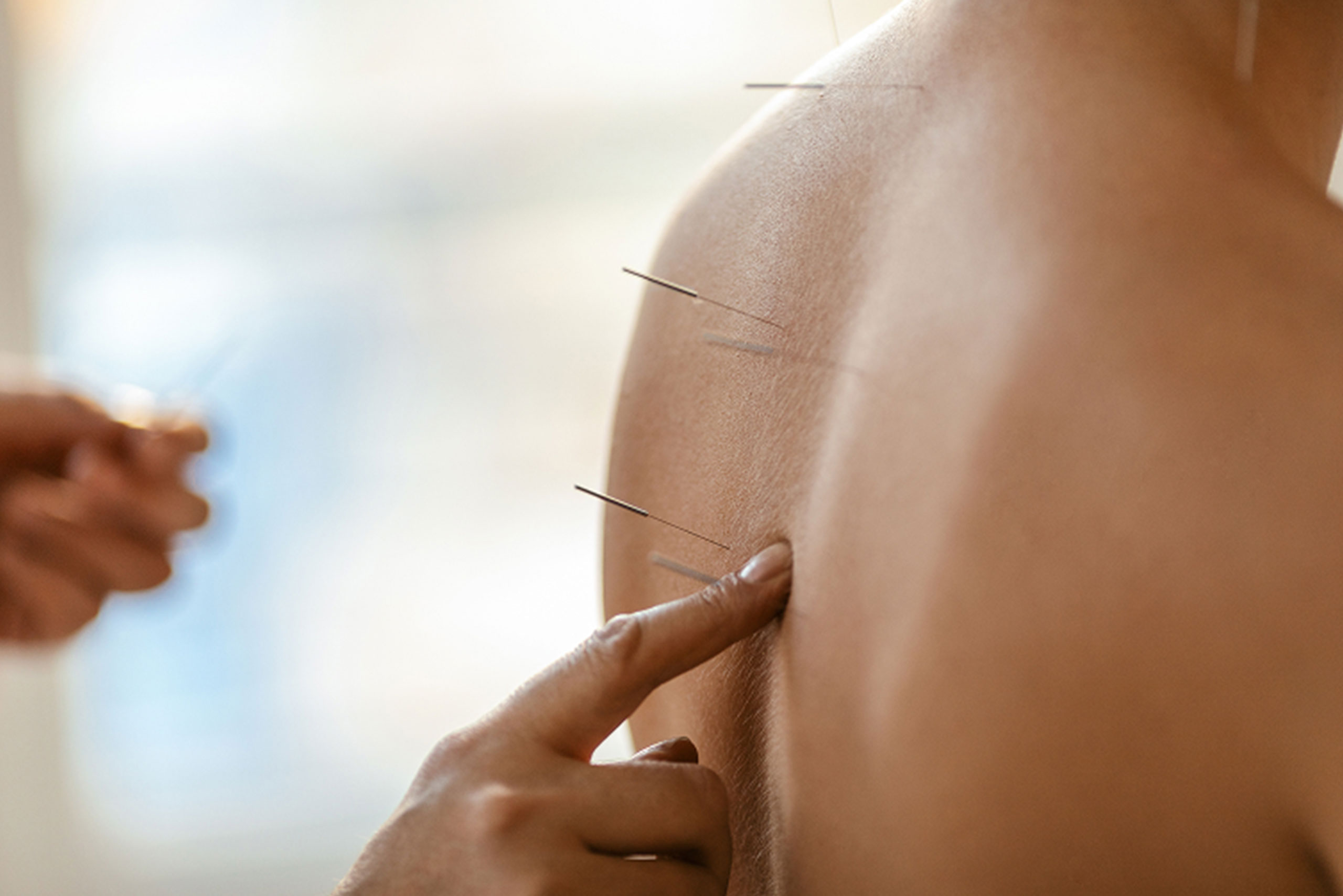 Close-up of a person's bare upper back with several thin acupuncture needles inserted. A practitioner's hand is gently touching near the needles, administering an acupuncture treatment.